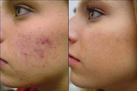 photo acne treatments before after