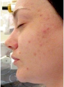 photo chemical peel for acne scars