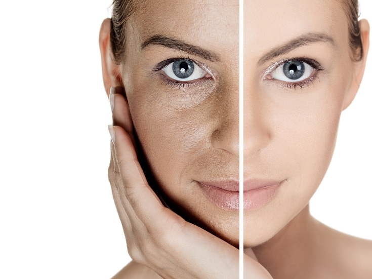 photo age spots, skin pigmentation on face