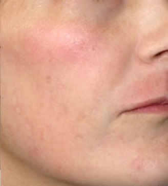 photo best medicine for spots on face
