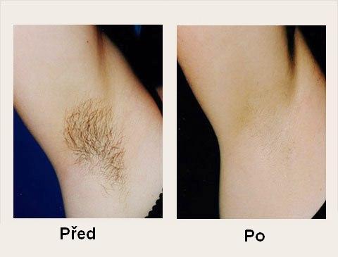 photo permanent armpit hair removal