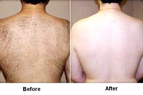 photo back hair removal