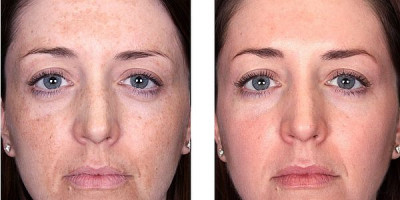 Face peeling treatment Face peeling treatment