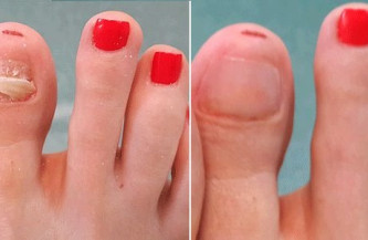 Ingrown toenail