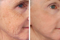 Face rejuvenation