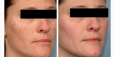 Chemical peel removal of pigmentation spots 