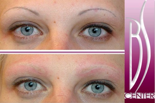 Permanent makeup laser removal