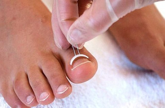 Ingrown toenail