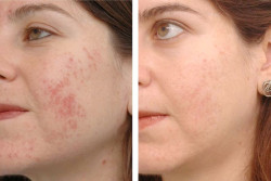 Face rejuvenation