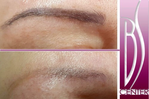Permanent makeup removal eyebrow laserem