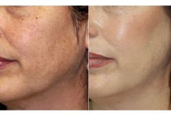 Face rejuvenation