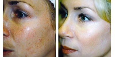 Skin lifting and skin refinement Skin lifting and skin refinement