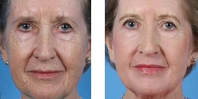 face peeling treatments for wrinkles