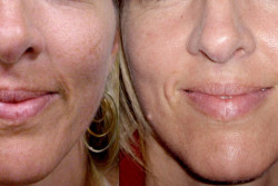 Face rejuvenation