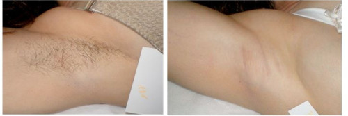 Фотоэпиляция в BEAUTYSHAPE