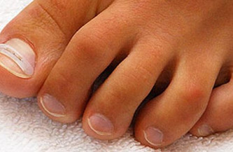 Ingrown toenail
