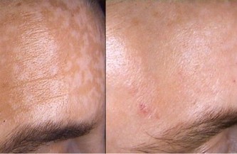 Age spots on face