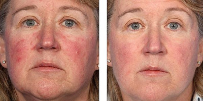 glycolic peel chemical glycolic peel chemical