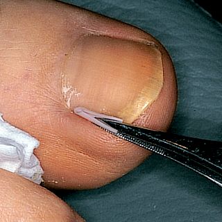 Фото Лечение вросших ногтей, удаление мозолей 