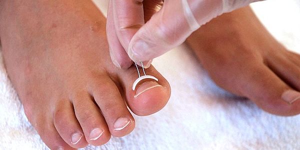 Ingrown Toenail removal. Foot care treatment | Podiatrist in Prague