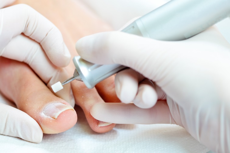 Ingrown Toenail removal. Foot care treatment | Podiatrist in Prague