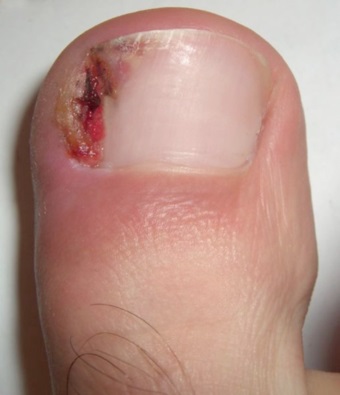 photo ingrown nail care