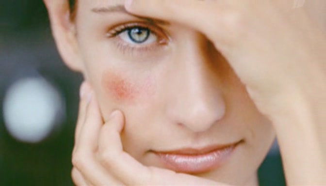 Фото Лечение купероза на лице 