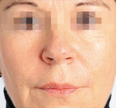 photo facelift without surgery