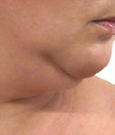 photo neck lift without surgery