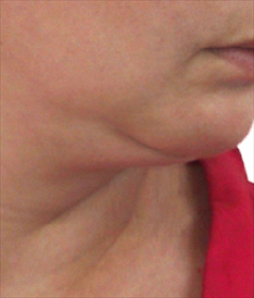 photo neck lift without surgery