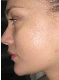 photo chemical peel for acne scars
