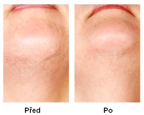 photo laser treatment for face hair removal