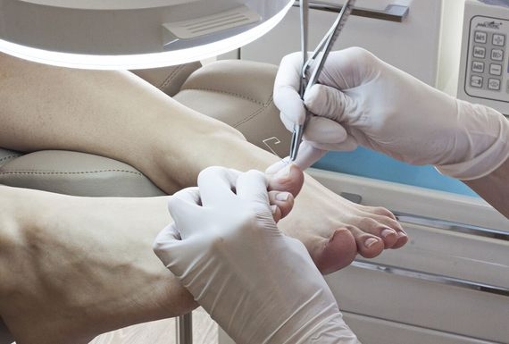 Ingrown toenail: Avoid surgeon