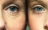 Puffy eyes. Dark Eye Circles treatment in Prague | BEAUTYSHAPE