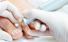 Ingrown Toenail removal without surgery